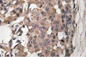 Immunohistochemistry (IHC) analyzes of Raf-B antibody in paraffin-embedded human breast carcinoma tissue. (BRAF antibody)