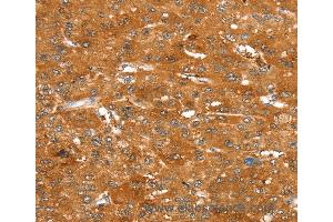 Immunohistochemistry of Human esophagus cancer using ABCC9 Polyclonal Antibody at dilution of 1:50 (ABCC9 antibody)
