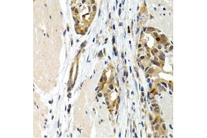 Immunohistochemistry of paraffin-embedded human stomach cancer using IL9 antibody. (IL-9 antibody)