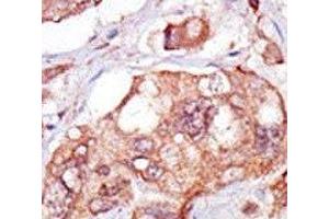 IHC analysis of FFPE human breast carcinoma tissue stained with the TNK1 antibody (TNK1 antibody  (AA 256-286))