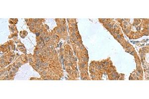 Immunohistochemistry of paraffin-embedded Human thyroid cancer tissue using ITGB1BP1 Polyclonal Antibody at dilution of 1:50(x200) (ITGB1BP1 antibody)