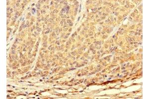 Immunohistochemistry of paraffin-embedded human ovarian cancer using ABIN7172897 at dilution of 1:100 (TKTL2 antibody  (AA 1-300))