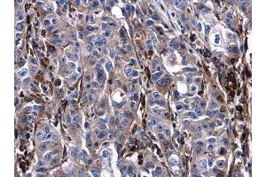 IHC-P Image Urokinase antibody detects Urokinase protein at cytoplasm and extracellular space in human esophageal carcinoma by immunohistochemical analysis. (PLAU antibody)