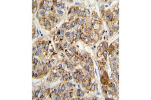 Formalin-fixed and paraffin-embedded human hepatocarcinoma with MCCC2 Antibody (Center), which was peroxidase-conjugated to the secondary antibody, followed by DAB staining. (MCCC2 antibody  (AA 163-189))