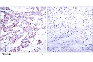 Immunohistochemical analysis of paraffin-embedded human breast carcinoma tissue using STAT6 (phospho T645) polyclonal antibody . (STAT6 antibody  (pThr645))