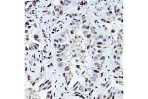 Immunohistochemistry of paraffin-embedded human lung cancer using Phospho-ATR-T1989 Rabbit pAb (ABIN7265777) at dilution of 1:200 (40x lens). (ATR antibody  (pThr1989))