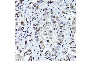 Immunohistochemistry of paraffin-embedded human lung cancer using Phospho-ATR-T1989 Rabbit pAb (ABIN7265777) at dilution of 1:200 (40x lens).