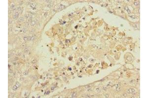Immunohistochemistry of paraffin-embedded human lung cancer using ABIN7157058 at dilution of 1:100 (ISCU antibody  (AA 1-167))