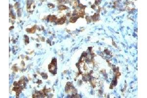 IHC testing of FFPE human gastric carcinoma with Cdc20 antibody (clone CLDC20-1) (CDC20 antibody)