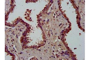 IHC image of ABIN7159706 diluted at 1:300 and staining in paraffin-embedded human prostate cancer performed on a Leica BondTM system. (MFAP4 antibody  (AA 100-191))
