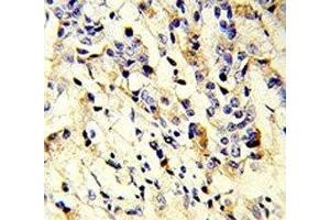 IHC analysis of FFPE human breast carcinoma stained with IGHM antibody (IGHM antibody  (AA 103-131))