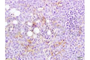 Formalin-fixed and paraffin embedded rat transplantation tumor tissue labeled with Anti-MTUS1 Polyclonal Antibody, Unconjugated  at 1:200 followed by conjugation to the secondary antibody and DAB staining (MTUS1 antibody  (AA 1151-1270))