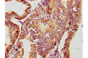 IHC image of ABIN7163242 diluted at 1:100 and staining in paraffin-embedded human endometrial cancer performed on a Leica BondTM system. (GPLD1 antibody  (AA 310-565))