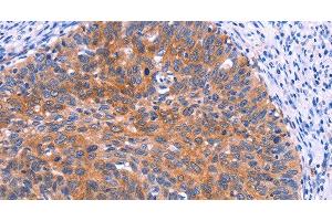 Immunohistochemistry of paraffin-embedded Human cervical cancer tissue using PTPN13 Polyclonal Antibody at dilution 1:30 (PTPN13 antibody)