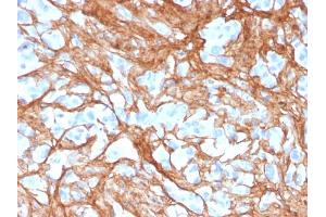 Formalin-fixed, paraffin-embedded human colon carcinoma stained with Periostin (POSTN) Mouse Monoclonal Antibody (POSTN/3501). (Periostin antibody  (AA 193-326))
