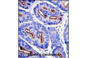 FOLH1 Antibody (N-term) (ABIN657630 and ABIN2846626) immunohistochemistry analysis in formalin fixed and paraffin embedded human prostate carcinoma followed by peroxidase conjugation of the secondary antibody and DAB staining. (PSMA antibody  (N-Term))
