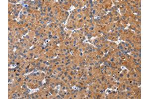 The image on the left is immunohistochemistry of paraffin-embedded Human liver cancer tissue using ABIN7193094(ZFAND2A Antibody) at dilution 1/30, on the right is treated with synthetic peptide. (ZFAND2A antibody)