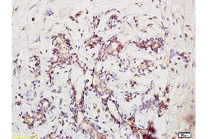 Formalin-fixed and paraffin embedded human pneumonia tissue labeled with Anti-Phospho-IRAK1 (Ser376) Polyclonal Antibody, Unconjugated at 1:200 followed by conjugation to the secondary antibody and DAB staining (IRAK1 antibody  (pSer376))