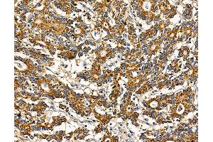 ABIN7095770 and ABIN7099832 at 1/100 staining human colorectal cancer by IHC-P.