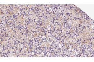 ABIN6273080 at 1/100 staining Human lymph cancer tissue by IHC-P. (TIMM22 antibody  (Internal Region))