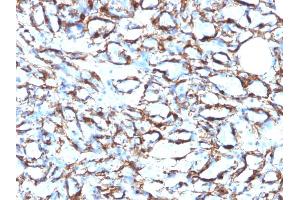 Formalin-fixed, paraffin-embedded human Angiosarcoma stained with Smooth Muscle Actin MAb (1A4 + ACTA2/791). (Smooth Muscle Actin antibody  (N-Term))