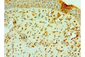 Immunohistochemistry of paraffin-embedded human prostate cancer using ABIN7147105 at dilution of 1:100 (CNOT8 antibody  (AA 1-292))