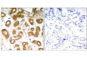 Immunohistochemical analysis of paraffin-embedded human breast carcinoma tissue using NFκB-p65 (Ab-505) Antibody (E021178). (NF-kB p65 antibody)