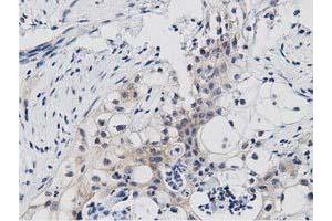 Immunohistochemical staining of paraffin-embedded Carcinoma of Human pancreas tissue using anti-PRKD2 mouse monoclonal antibody. (PKD2 antibody)