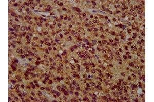 IHC image of ABIN7176659 diluted at 1:400 and staining in paraffin-embedded human glioma performed on a Leica BondTM system.