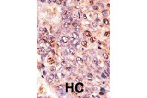 Formalin-fixed and paraffin-embedded human hepatocellular carcinoma tissue reacted with ABCB7 polyclonal antibody  , which was peroxidase-conjugated to the secondary antibody, followed by DAB staining. (ABCB7 antibody  (C-Term))