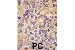 Formalin-fixed and paraffin-embedded human prostate carcinoma tissue reacted with PLAU polyclonal antibody  , which was peroxidase-conjugated to the secondary antibody, followed by DAB staining. (PLAU antibody  (C-Term))