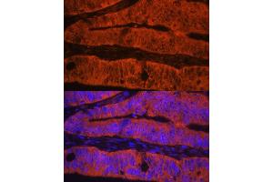 Immunofluorescence analysis of human colon carcinoma using TLN1 antibody (ABIN1683044, ABIN3018627, ABIN3018628 and ABIN6220520) at dilution of 1:100. (TLN1 antibody  (AA 1-220))