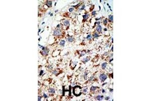 Formalin-fixed and paraffin-embedded human cancer tissue reacted with the primary antibody, which was peroxidase-conjugated to the secondary antibody, followed by AEC staining. (UBA2 antibody  (C-Term))