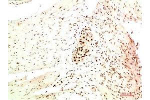 Immunohistochemical analysis of paraffin-embedded Human Colon Carcinoma Tissue using HP-1 α Mouse mAb diluted at 1:200. (CBX5 antibody)