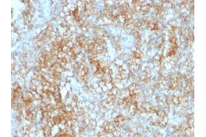 Formalin-fixed, paraffin-embedded human Renal Cell Carcinoma stained with CD147 Mouse Monoclonal Antibody (8D6). (CD147 antibody)