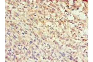 Immunohistochemistry of paraffin-embedded human melanoma using ABIN7145991 at dilution of 1:100