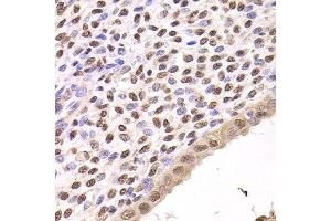 Immunohistochemistry of paraffin-embedded human adenomyosis using FKBP4 Antibody. (FKBP4 antibody  (AA 220-459))