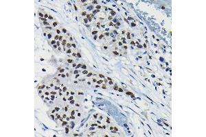 Immunohistochemistry of paraffin-embedded human lung cancer using A Rabbit pAb (ABIN6131196, ABIN6137102, ABIN6137103 and ABIN6223591) at dilution of 1:100 (40x lens). (ARID3A antibody  (AA 324-593))