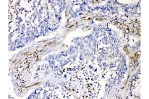 IHC testing of FFPE human lung cancer tissue with VASP antibody at 1ug/ml. (VASP antibody  (AA 78-114))