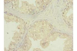 Immunohistochemistry of paraffin-embedded human prostate cancer using ABIN7174808 at dilution of 1:100 (C20orf195 antibody  (AA 10-310))
