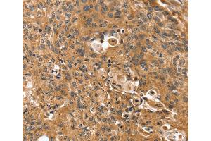 Immunohistochemistry (IHC) image for anti-Synovial Sarcoma, X Breakpoint 2 Interacting Protein (SSX2IP) antibody (ABIN2430871) (SSX2IP antibody)