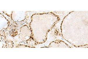 Immunohistochemistry of paraffin-embedded Human thyroid cancer tissue using GTF3C2 Polyclonal Antibody at dilution of 1:45(x200) (GTF3C2 antibody)