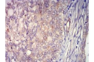 Immunohistochemical analysis of paraffin-embedded cervical cancer tissues using CD156 mouse mAb with DAB staining.