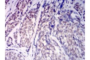 Immunohistochemical analysis of paraffin-embedded esophageal cancer tissues using KDM1A mouse mAb with DAB staining. (LSD1 antibody  (AA 709-876))