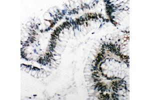 Anti-53BP1 antibody, IHC(P) IHC(P): Human Intestinal Cancer Tissue (TP53BP1 antibody  (C-Term))