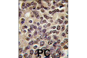 Formalin-fixed and paraffin-embedded human prostate carcinoma tissue reacted with PKN3 polyclonal antibody  , which was peroxidase-conjugated to the secondary antibody, followed by DAB staining. (PKN3 antibody  (C-Term))