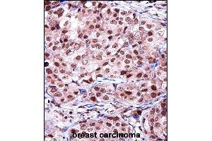 TERF2IP Antibody (C-term) ((ABIN657968 and ABIN2846914))immunohistochemistry analysis in formalin fixed and paraffin embedded human breast carcinoma followed by peroxidase conjugation of the secondary antibody and DAB staining. (RAP1 antibody  (C-Term))