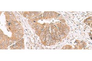 Immunohistochemistry of paraffin-embedded Human colorectal cancer tissue using HMGCLL1 Polyclonal Antibody at dilution of 1:70(x200) (HMGCLL1 antibody)