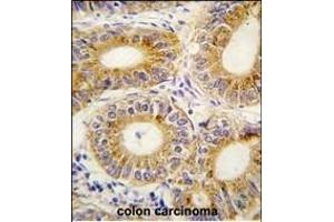 Formalin-fixed and paraffin-embedded human colon carcinoma tissue reacted with YARS2 antibody (C-term) (ABIN1882153 and ABIN2841956) , which was peroxidase-conjugated to the secondary antibody, followed by DAB staining. (YARS2 antibody  (C-Term))