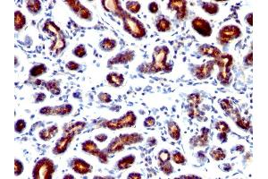 Formalin-fixed, paraffin-embedded human breast Carcinoma stained with pS2 Monoclonal Antibody (TFF1/1091). (TFF1 antibody  (C-Term))